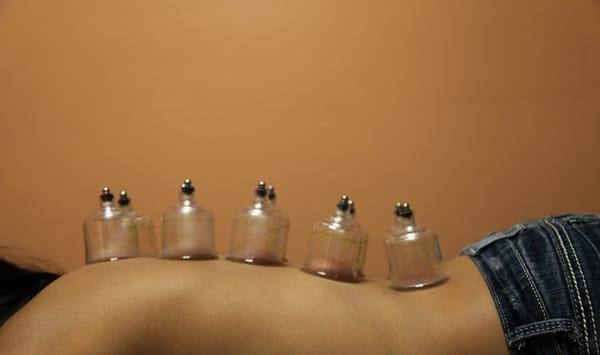 Cupping.