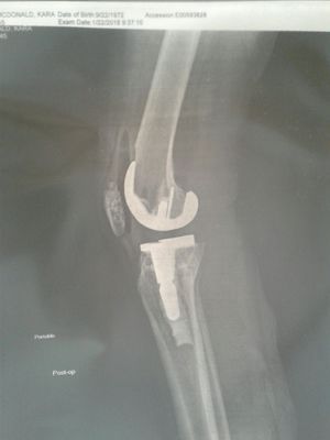 My femur was so bad Dr had to reinforce with an extra screw... look at all that space between it's gorgeous.