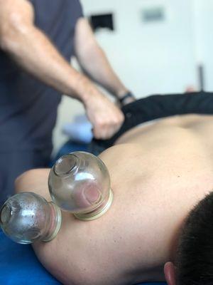 Stationary Cupping