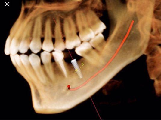 3D x-Ray(CBCT). Low radiation Green CT. For better diagnosis & treatment planning including computer guided implant procedures.