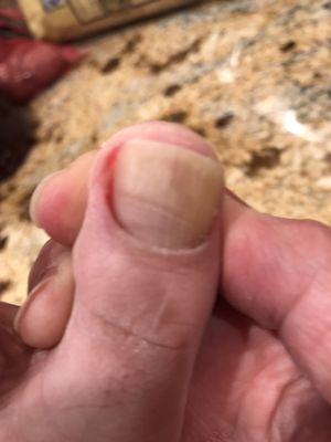 Too aggressive with nippers made my toe bleed!  Warning!