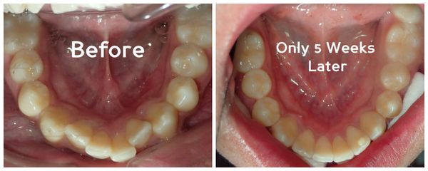 Before and after picture of teeth-straightening treatment with Inman Aligners. Click here to see how they work https://www.yo...