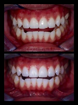 Dr. Brian Lesage and his beautiful Art work on my teeth. No more chipped teeth for me!