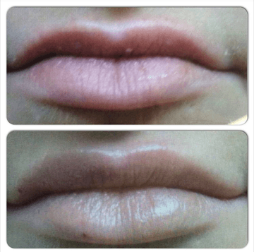 Amazing Lip Augmentation by Nurse Patty