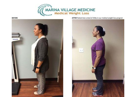 Medical Weight Loss Before and After in Alameda, CA