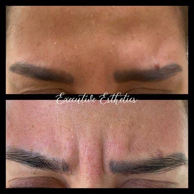 Before and After Xeomin to Relax Dynamic Wrinkles