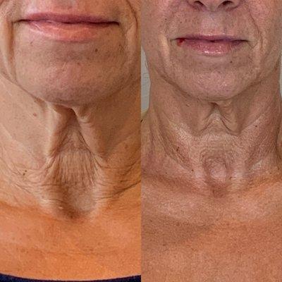 SkinTyte a "No Downtime" laser treatment for common laxity areas such as: neck, lower face and abdomen