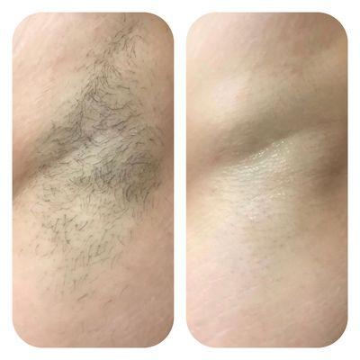 Underarm wax Before and After