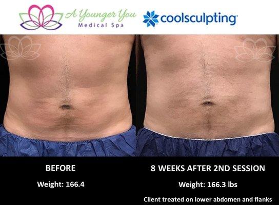 Before & After Coolsculpting on Male