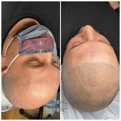 Scalp Micropigmentation (SMP)