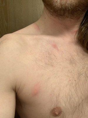 Bed bug bites on neck, shoulder, and chest 24hrs later