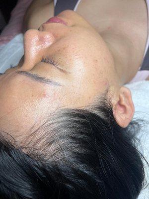 Post dermaplane + high frequency wand.