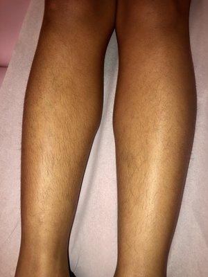 Before lower leg hair removal (sugar paste)