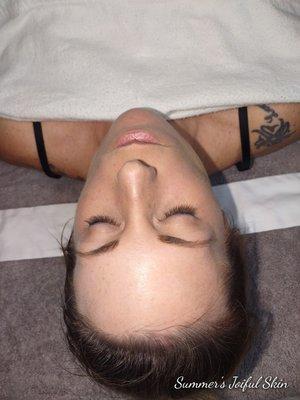 Dermaplane Facial after