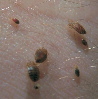 Bed bugs (Adults & Nymphs) on skin