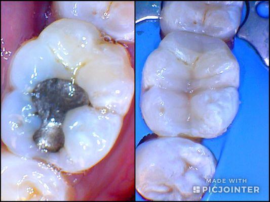 Cosmetic (biomimetic) restoration. Replacement of amalgam with esthetic composite.