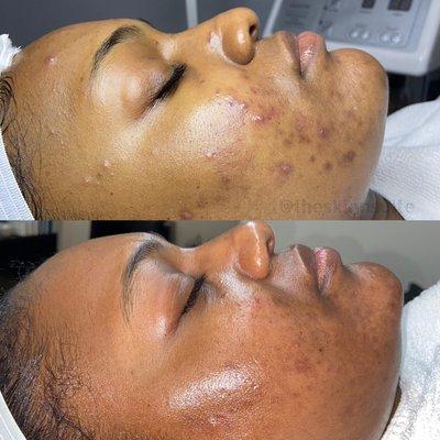 Acne Transformation