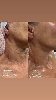 QI BEAUTY FACE AND NECK TREATMENT - visit website for more information on this service