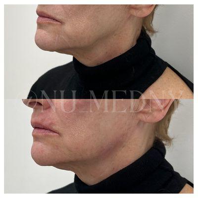 Before & After of Chin Filler