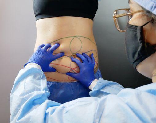 CoolSculpting