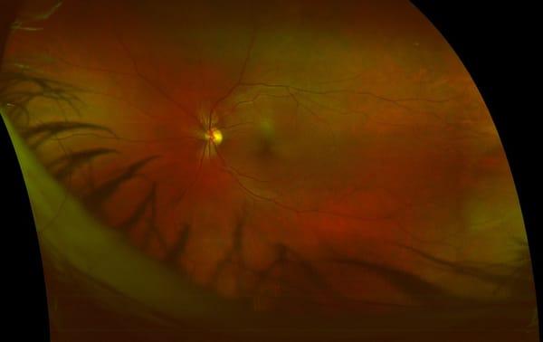 Optomap eye exam image