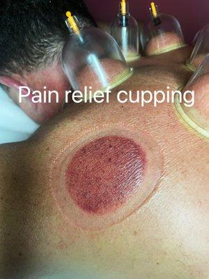 Cupping that hello relief the pain ,stress and bad energy