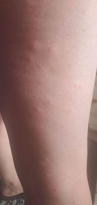 my legs are ate up with bug bites.