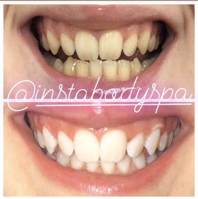 30 minute professional teeth whitening!! Wow, what a difference..Book today!