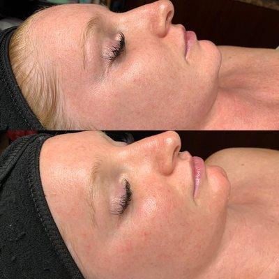 Dermaplaning