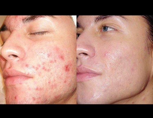 Acne treatment for men, women and teens.