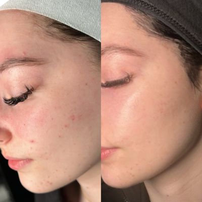 Acne treatment results after peels & consistent facials