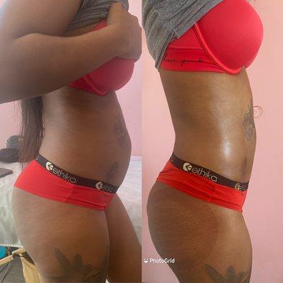 1 laser lipo treatment