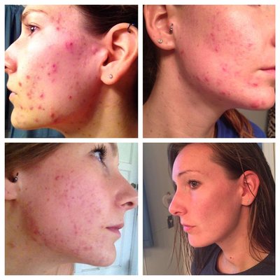 Photos showing Suzanne's client's progression throughout treatment for her condition.