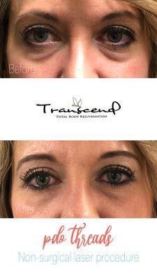 Before and After PDO Thread on Under Eyes