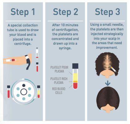 How PRP for hair works!