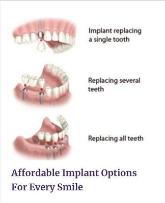 Replace missing teeth... free implant consultations