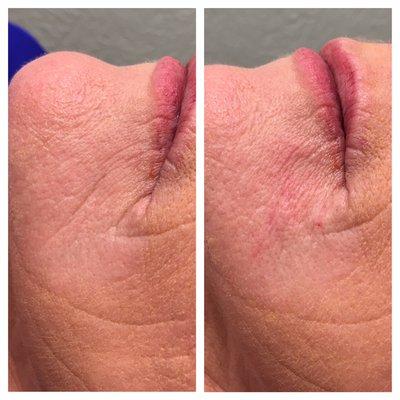 Now you see a wrinkle, now you don't. Volbella erased a wrinkle on this client's chin.