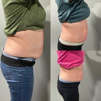 I-lipo.... Laser LED lipo after 4 sessions only.