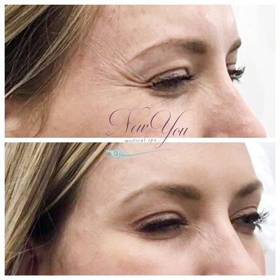 Dysport/Botox: Crows feet