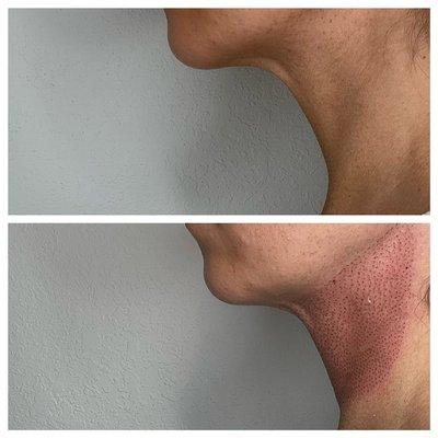 Before and immediately after Plasma treatment.