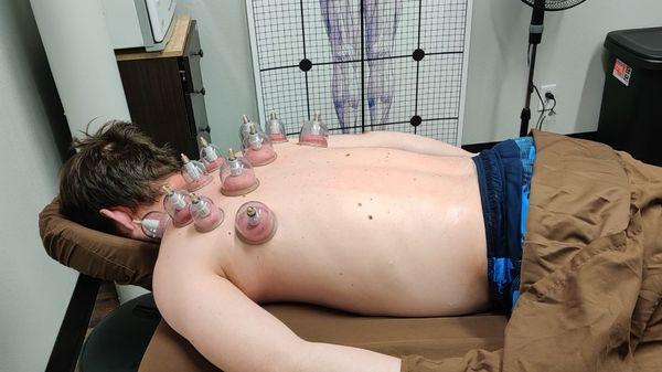 Cupping