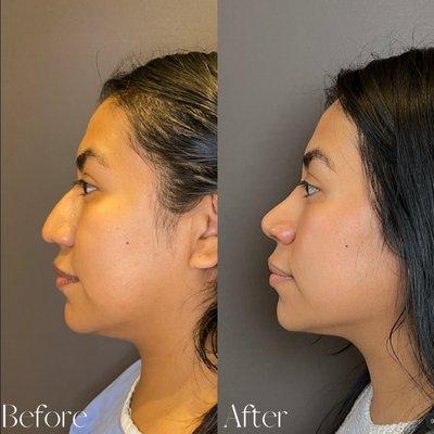 Female 1 Year After Closed Rhinoplasty