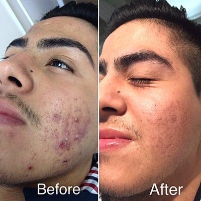 Our treatments reduce scars while clearing acne.