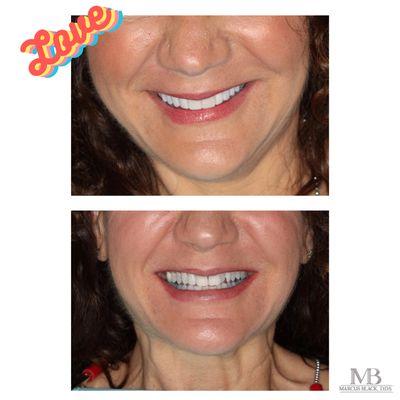 Wow... Amazing Smile Makeover!