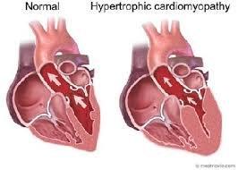 Caring About Hearts