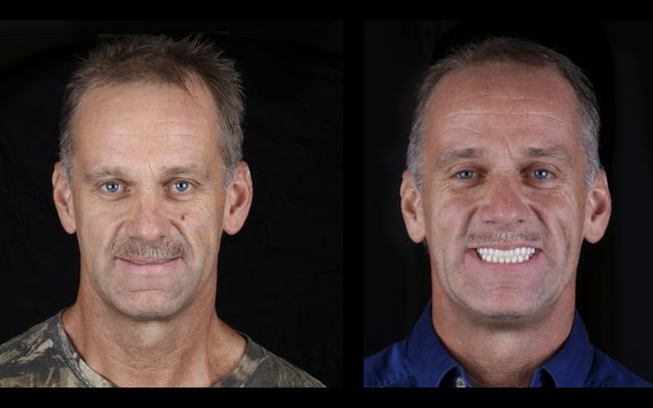 Before/After Dental Implants Advanced General Dentistry IV sedation  Extractions