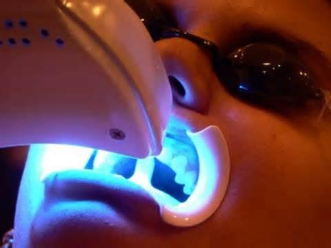 60 Minute In-Office Teeth Whitening