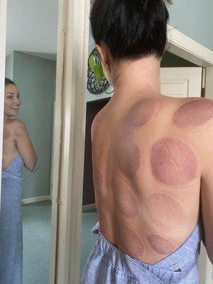 Cupping pre massage with Emily, has never felt better!