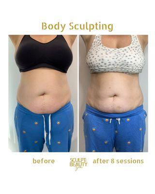 Body Sculpting (Abdomen Session)