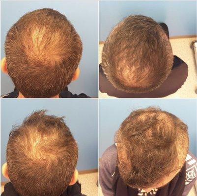 Before and after 2500 grafts pictures taken  by the office